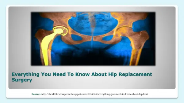 Everything You Need To Know About Hip Replacement Surgery