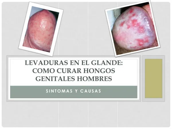 Levaduras en el Glande: Como Curar Hongos Genitales Hombres Sintomas y Causas