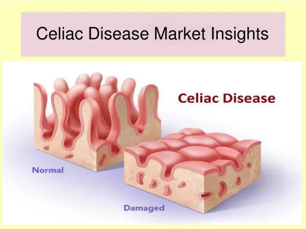 Celiac Disease Market Reports