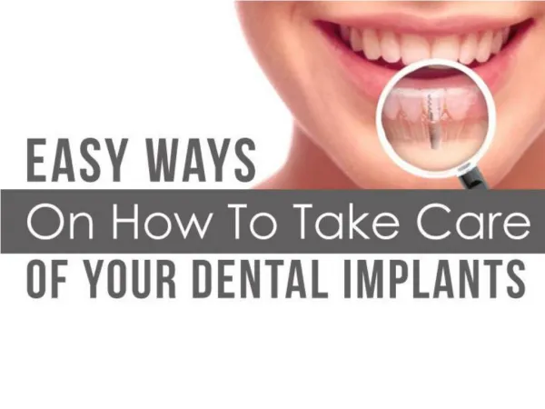 Easy Ways On How To Take Care Of Your Dental Implants