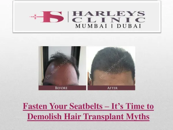 Fasten Your Seatbelts – It’s Time to Demolish Hair Transplant Myths
