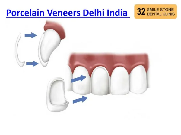 Porcelain Veneers Delhi India