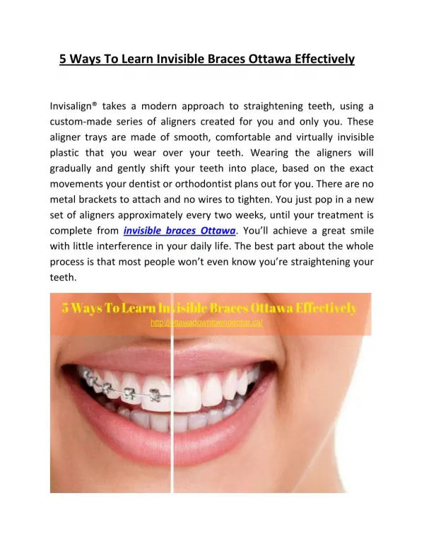 5 Ways to Learn Invisible Braces Ottawa Effectively