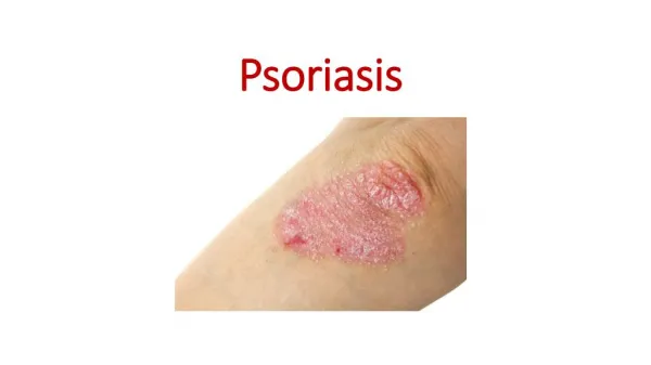 All About Psoriasis