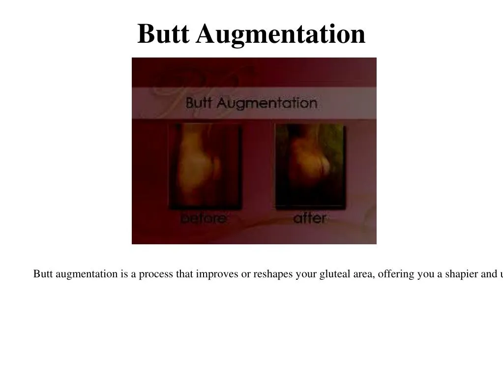 butt augmentation