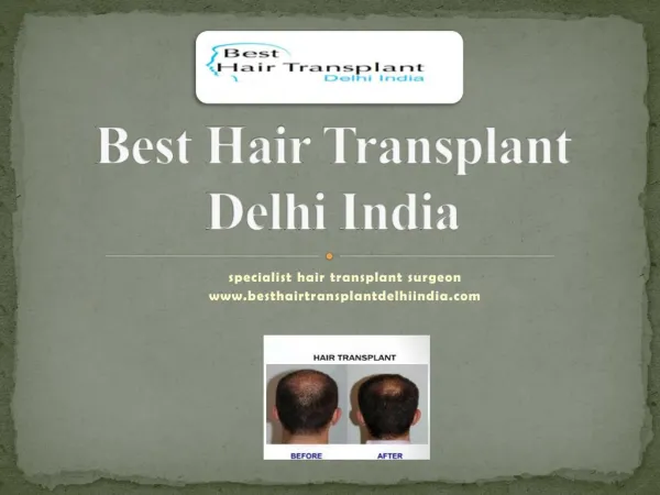 Best Hair Transplant FUE, FUT, Eyebrow Delhi, Hair Loss Treatment India