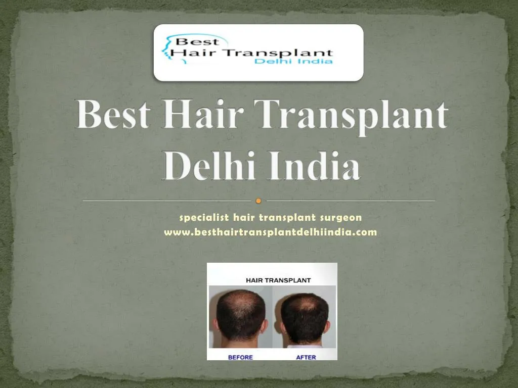 best hair transplant delhi india