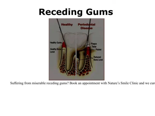 Cure receding gums