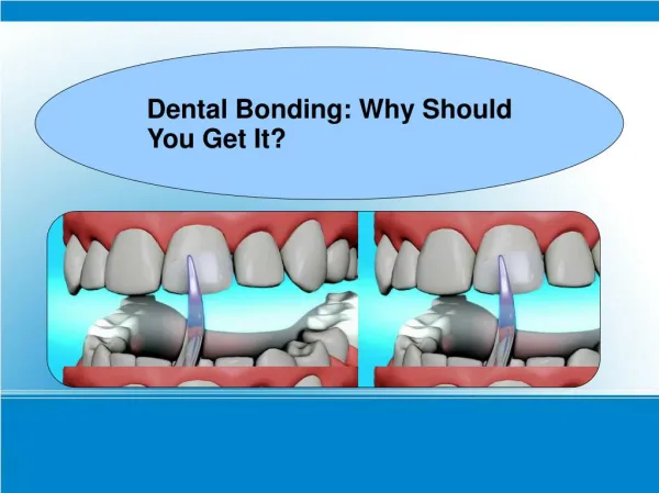 Dental Bonding: Why Should You Get It?