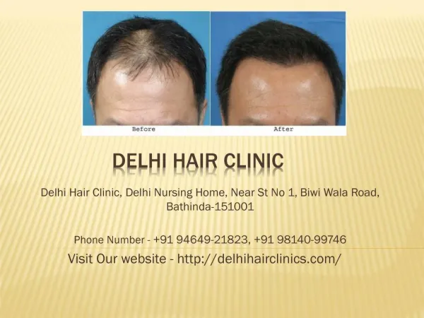 hair transplant clinic in punjab,Delhi