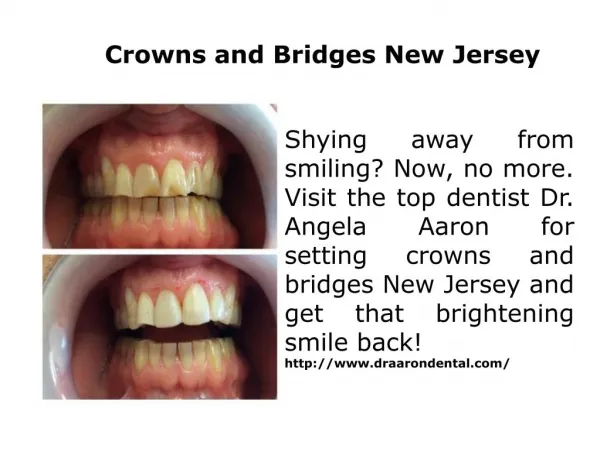 Crowns and Bridges New Jersey