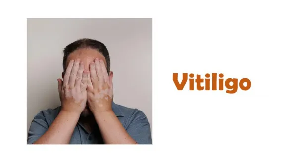 Everything you wanted to know about vitiligo