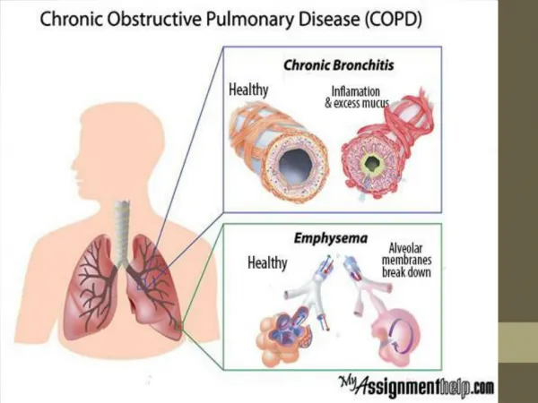 Chronic Obstructive Pulmonary Disease: A Comprehensive Case Study