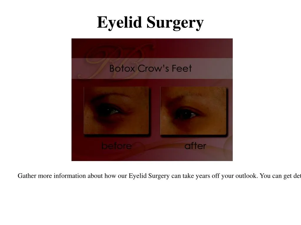 eyelid surgery