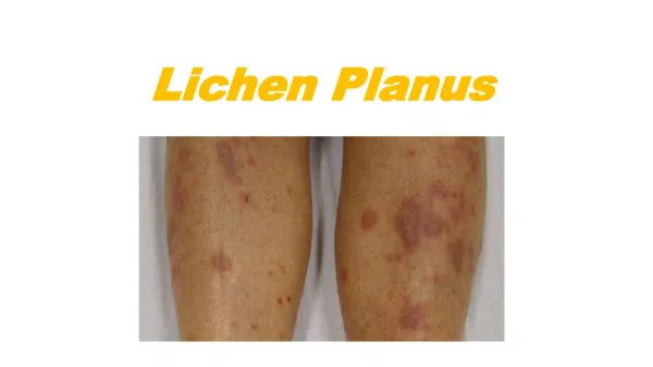 Lichen planus - complete knowledge