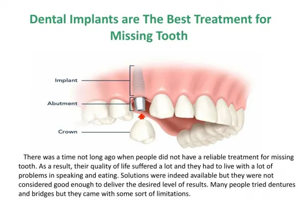 Dental implants are the best treatment for missing tooth