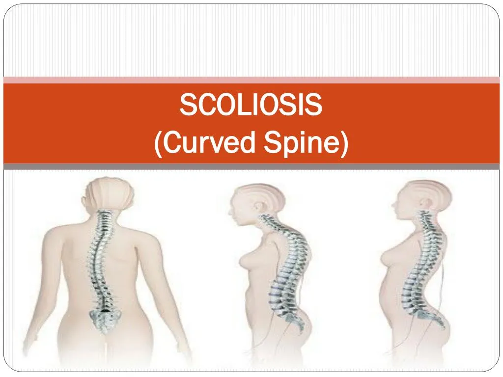 scoliosis curved spine