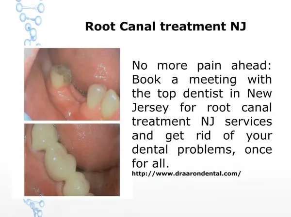 Root Canal treatment NJ