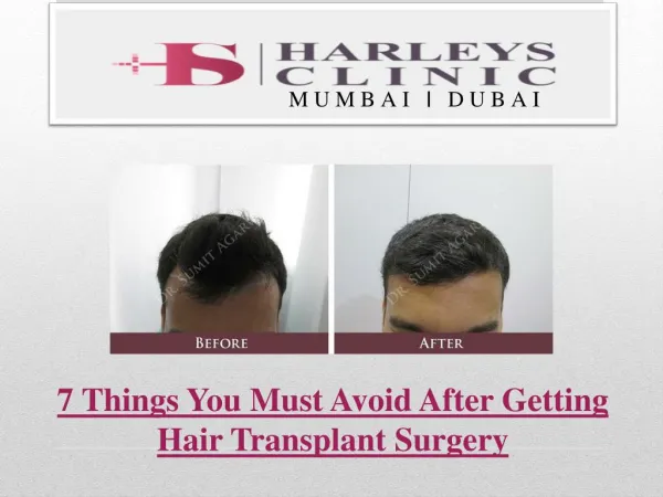 7 Things You Must Avoid After Getting Hair Transplant Surgery