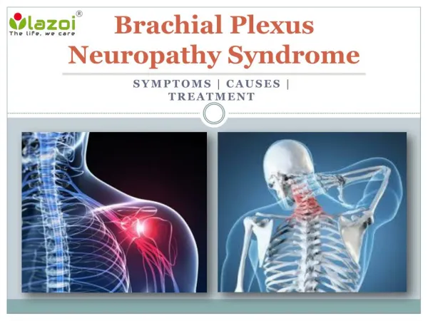 Brachial Plexus Neuropathy Syndrome : Causes, Symptoms, Daignosis and Treatment
