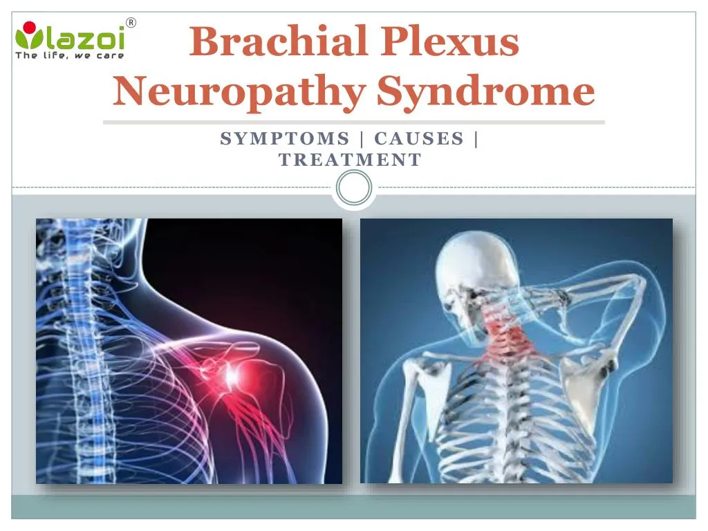 brachial plexus neuropathy syndrome