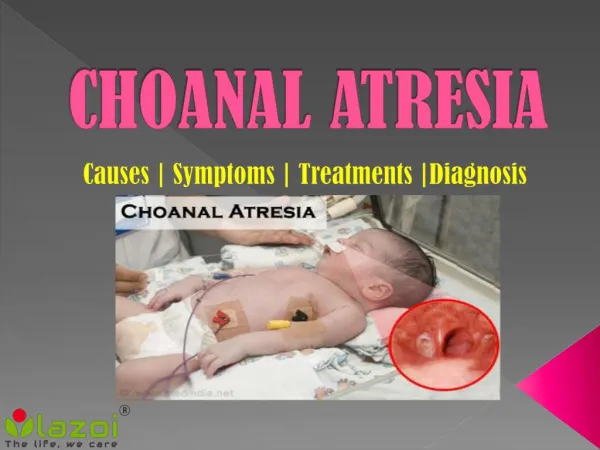 Choanal atresia: Symptoms, causes, treatment and Prevention.