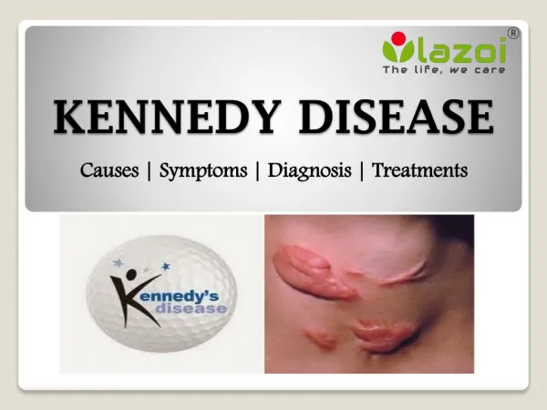 Kennedy disease: symptoms, causes, diagnosis and treatment.