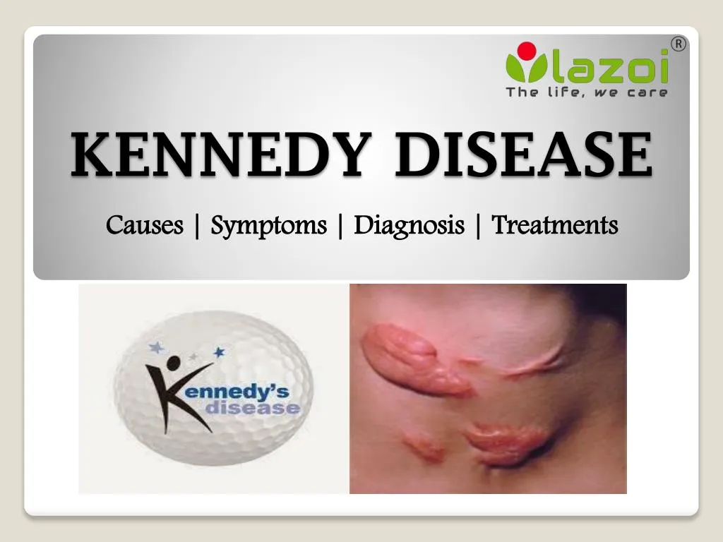 kennedy disease