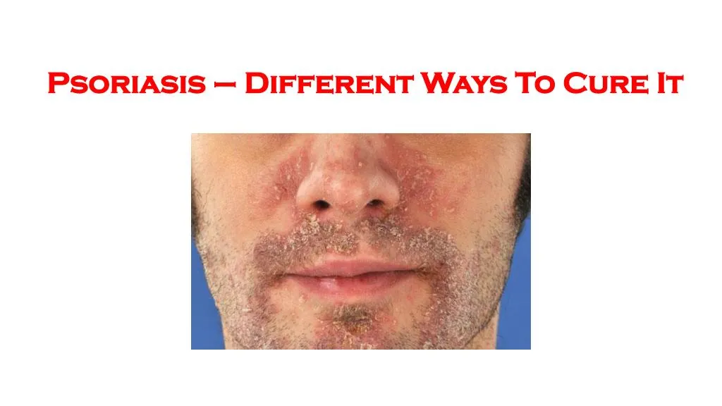 psoriasis different ways to cure it