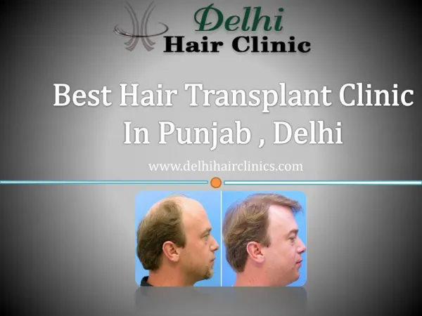 Get natural hair with hair transplant clinic in Punjab,Delhi