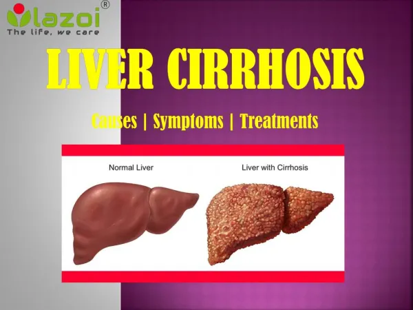 Cirrhosis of the Liver: A critical health condition.