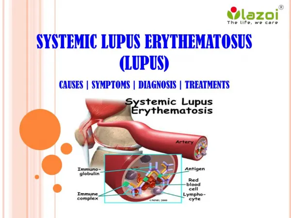 Systemic lupus erythematosus (lupus): Disease of the immune system