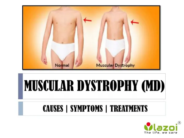 Muscular dystrophy: Group of more than 30 inherited diseases.