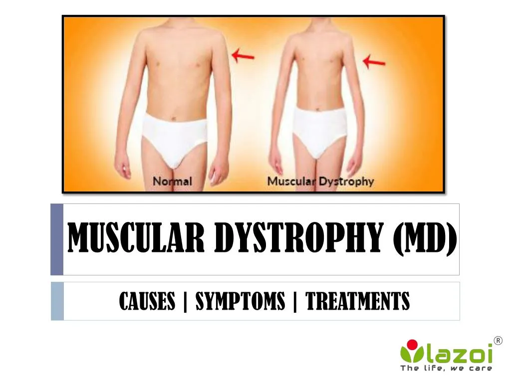 muscular dystrophy md