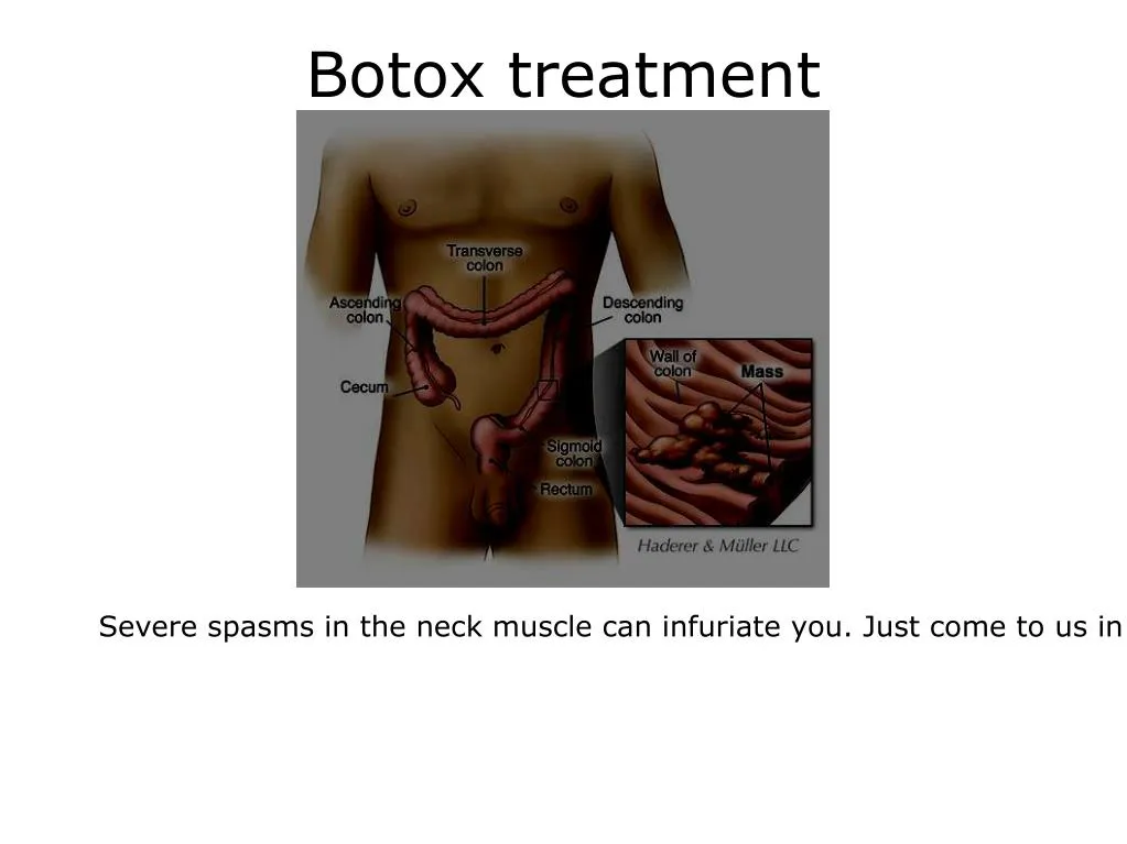botox treatment
