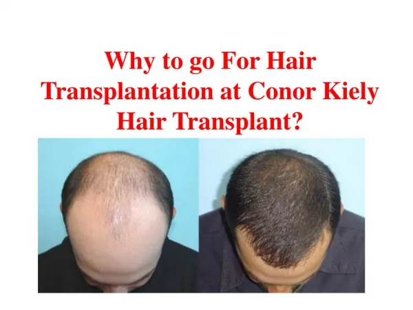 Why to go For Hair Transplantation at Conor Kiely Hair Transplant?
