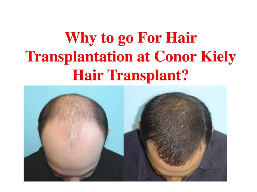 why to go for hair transplantation at conor kiely hair transplant