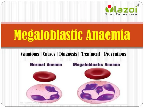 Megaloblastic Anaemia: Symptoms, causes, diagnosis, treatment and preventions.