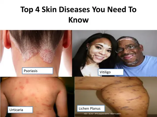 Top 4 skin diseases you need to know