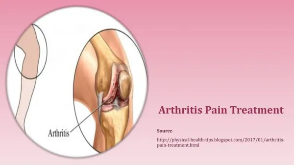 Arthritis Pain Treatment