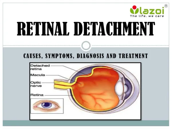 Retinal Detachment: Causes, Symptoms, Diagnosis and Treatment.