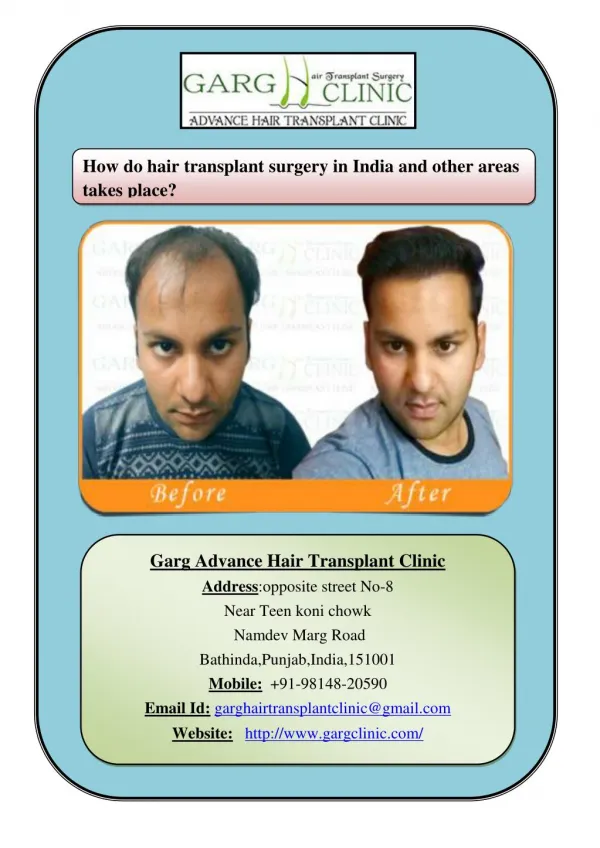 How do hair transplant surgery in India and other areas takes place?