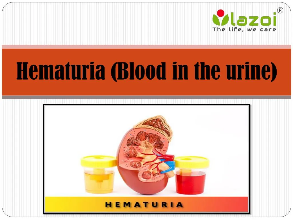 hematuria blood in the urine