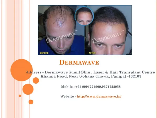 Best hair transplant and laser care treatment in India