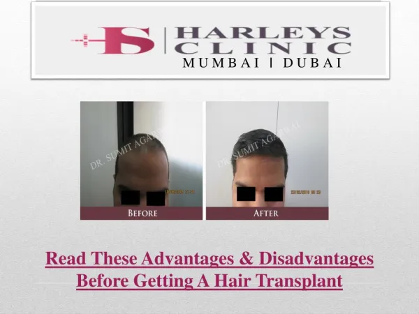 Read These Advantages & Disadvantages Before Getting A Hair Transplant