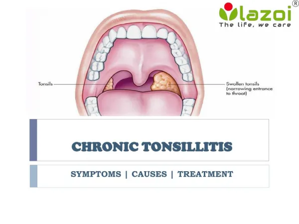 Chronic Tonsillitis: Symptoms, causes and treatment