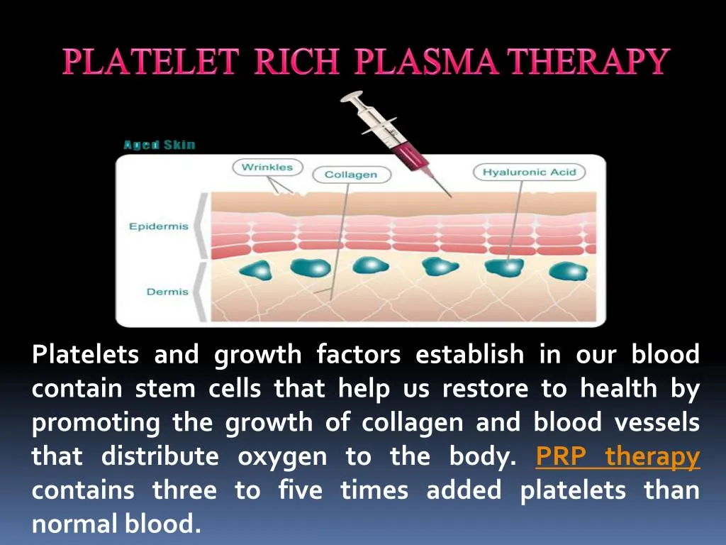 platelet rich plasma therapy