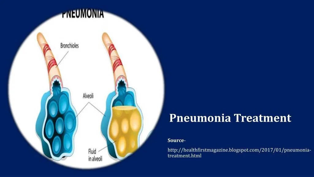 pneumonia treatment