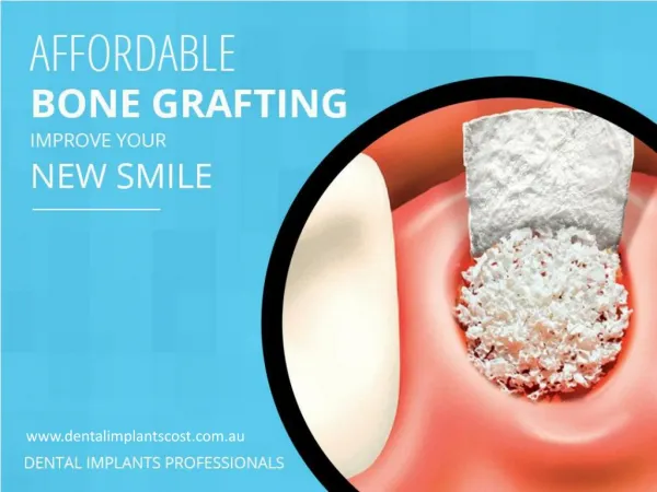 Affordable Bone Grafting- The Foundation of Your Beautiful Smile
