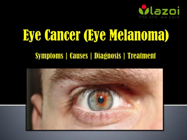 Eye Cancer (Eye Melanoma): Symptoms, Causes, Diagnosis and Treatment.